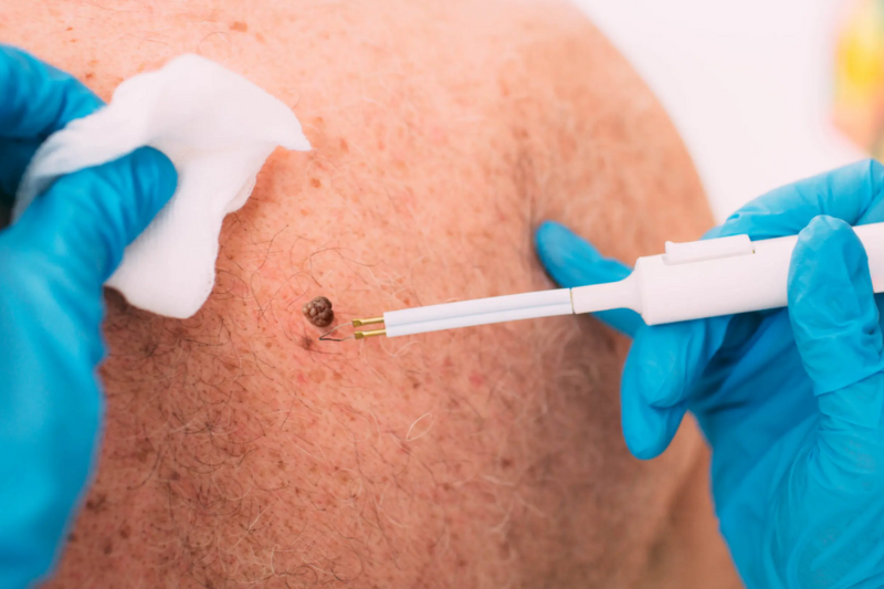 Skin Tag Removal